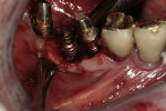 Figure 5  Two failing implants caused by peri-implantitis in the mandibular right second premolar and first molar areas (Nos. 29 and 30), requiring implant removal.