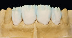 Figure 5  Full set-up with dentin-enamel, cut-back, and lengthening of the crown shape with enamel and transparent material.