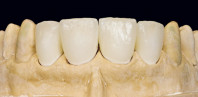 3D Printing: A Model for Dental Laboratories Webinar Thumbnail