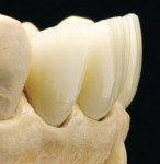 Figure 38  The remaining natural teeth should always be considered.