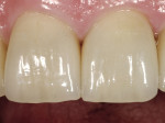 Figure 44  A few days after the definitive incorporation, the teeth re-hydrated and the soft tissue relaxed. The restoration looks very natural and lively.