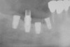 Fig 2. Periapical radiograph revealing the fractured central incisor.