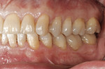 Figure 47  A few days after the definitive incorporation, the teeth re-hydrated and the soft tissue relaxed. The restoration looks very natural and lively.