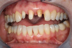 Figure 4  The dentist preparedteeth Nos. 7, 8, and 9 to receivethree IPS e.max crowns.