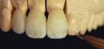 Figure 6  Layering ceramic wasapplied to the pressed crowns,and they were fired in the EP5000 combination furnace.