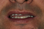 Figure 11  Clinical photograph of a patient who presented with a complaint of partial lower lip numbness, which has remained for 18 months, after the implant restoration was completed.