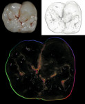 Figure 11  Although anterior workrequires more detail and willmost likely require polychromatic,multi-powder build-ups,GC"s Initial IQ – One Body,Layering-over-Metal is ideal forposterior work.