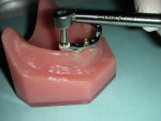 Minimally Traumatic Extractions and Implant Site Preservation Webinar Thumbnail