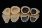 Figure  2   Spacing and the substructure will influence the final restoration esthetically, especially when trying to match different materials, ie, metal, zirconia, and all-ceramic.