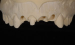 Figure  4  By using a cutback technique, the author could slightly mask the dentin and yet create a core similar in value to the adjacent veneers.