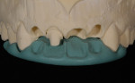 Figure  5  By using a cutback technique, the author could slightly mask the dentin and yet create a core similar in value to the adjacent veneers.