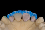 Figure  10  Dentin, enamels, and translucents were built to frame tooth shape and create the canvas upon which the other ceramic materials would be layered.