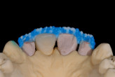 The Digital Denture Revolution Webinar Thumbnail