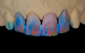 The Anterior Single-Tooth Site: Maximizing Bone Volume and Soft Tissue Contours Webinar Thumbnail
