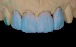 Figure  15  Enamels and translucents were applied from 0.3 mm to 0.5 mm (cervical to incisal) to cover and filter the underlying effects.