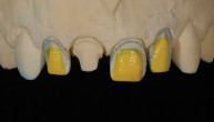 Perspectives on Modern Implant Dentistry Webinar Thumbnail