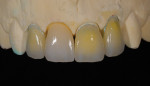 Figure  18  After the final restorations were glazed, polished, and de-vested, they were fit to the original dies.