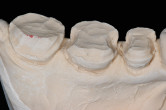 Material Selection and Placement Technique for Successful Class 2 Composite Resin Restorations Webinar Thumbnail