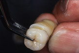 Surgically Facilitated Orthodontic Therapy (SFOT). An interdisciplinary approach Webinar Thumbnail