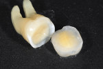 Figure  13  All posterior teeth when prepared in the described fashion will exhibit a definite rim of enamel surrounding the dentin (left side). This scheme can easily be transitioned to the restoration (right side).