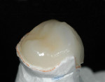 Figure  29  Using the transition color layering technique it is possible to obtain an almost seamless bond between the natural tooth and the restoration. Photo courtesy of R. Alpert, DDS.