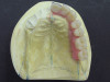 (17.) The esthetic, functional, and phonetic changes were evaluated and confirmed in the provisional restorative phase.