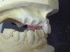 (18.) The provisional restorations show the vertical and horizontal changes in the incisal edge position.