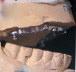 Figure  1   The difficulties in the implant bar case centered on unidentified implants and a worn implant bar cast from an unidentified alloy.
