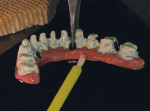 Figure 22  To begin creation ofthe denture teeth, GC GradiaOpaque was layered onto theimplant bar.