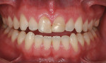 Figure 1  Retracted preoperative view of the 21-year-old patient with chipped maxillary central incisors.