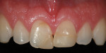 Figure 2  Close-up preoperative view of the chipped incisors with preventive composite resins.