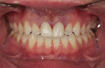 Figure 3  Teeth Nos. 8 and 9 were prepared for crown restorations and the preparations were polished.