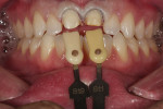 Figure 4  Acrylic provisional crowns were created from the preoperative PVS impression and the teeth were provisionalized.