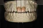 Figure 6  Full-contour wax-ups of the anticipated restorations created on the solid model.