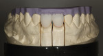 Figure 8  Cutbacks were completed after the fit of the restorations was verified and the incisal matrix was placed on the model to verify the proper reduction.