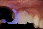 Figure 18  The crown restorations were light-cured into place.