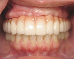 Figure 3B  Zirconia framework with porcelain veneer can be fabricated as a cement-retained or screw-retained prosthesis. The junction of the prosthesis and the gingiva needs to be hidden well above the smile line for an optimal esthetic result.