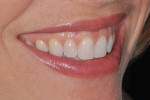 Figure 3e  Left lateral smile
