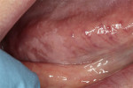 Figure 1  This leukoplakic patch on the right lateral border/ventral tongue was histologically diagnosed as hyperkeratosis without dysplasia. A comment was added to the sign-out diagnosis, 