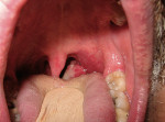 Figure 6  The erythroplakia on the left soft palate was biopsied and histologically diagnosed as a severe epithelial dysplasia, while the lesion on the left palatine tonsil was diagnosed as a squamous cell carcinoma.