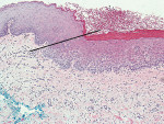 Figure 7  The line shows the demarcation between normal epithelium on the left and the mild epithelial dysplasia on the right side.