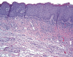 Figure 8  In moderate epithelial dysplasia, the disruption in the normal maturation pattern involves less than the lower two-thirds of the epithelium.