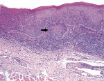 Figure 9: The arrow identifies an abnormal mitotic figure in this example of severe epithelial dysplasia.