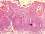Figure 10  Carcinoma-in-situ has not yet breached the basement membrane to become locally invasive; the arrow identifies a keratin pearl deep within a rete ridge.