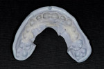 Figure 3  After removal from the prepared teeth, a self-cure bisacryl material is allowed to cure outside of the mouth.