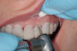 Figure 7  Intraoral curing of the provisional restorations can necessitate intraoral trimming of the excess material.