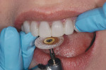 Figure 11  Rotary instruments can be used to reduce length and excessive contours of the provisional restorations.