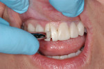 Figure 15  Provisional restorations are removed from one half of the preparations, using the patient’s midline as the dividing line.