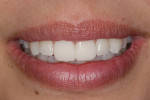 Figure  19  One week after the gingival margins were leveled and the central incisors were prepared for porcelain veneers, the provisional restorations were evaluated and adjusted.