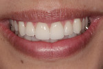 Figure 20  Photographs and models of the approved provisional restorations provided a template for the final restorations, which duplicated the esthetic and functional requirements that were established.